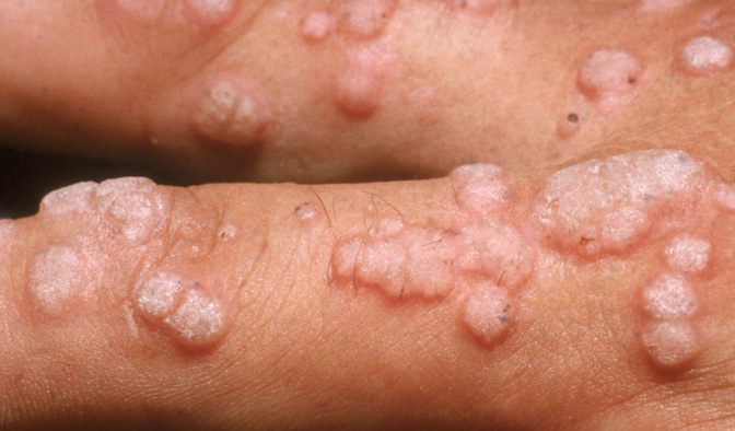 Infección del (HPV) carcinogénico