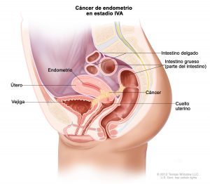 Estadios en el cáncer de endometrio