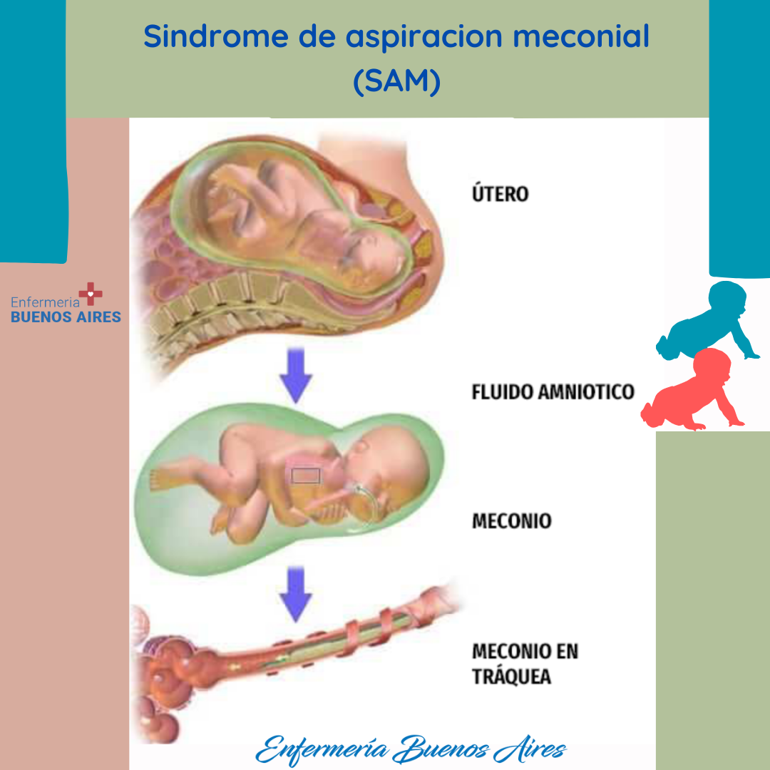 S Ndrome De Aspiraci N Meconial Causas Y Tratamiento