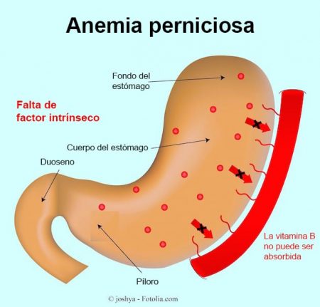 anemia perniciosa