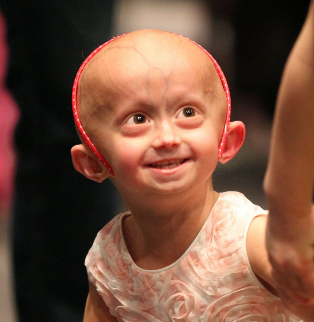 progeria2