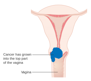 Diagram showing stage 2A cervical cancer CRUK 212.svg