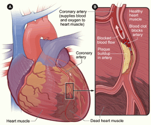 Heart attack NIH