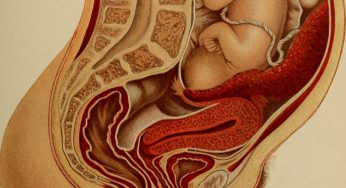 Muerte fetal intrauterina