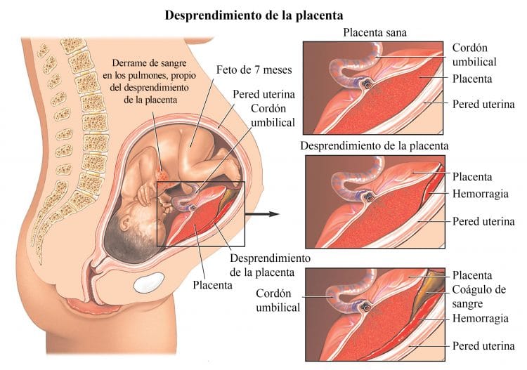 Desprendimiento de la placenta