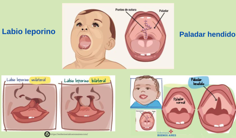Tomar poco ácido fólico embarazada causa deformidades en la lengua
