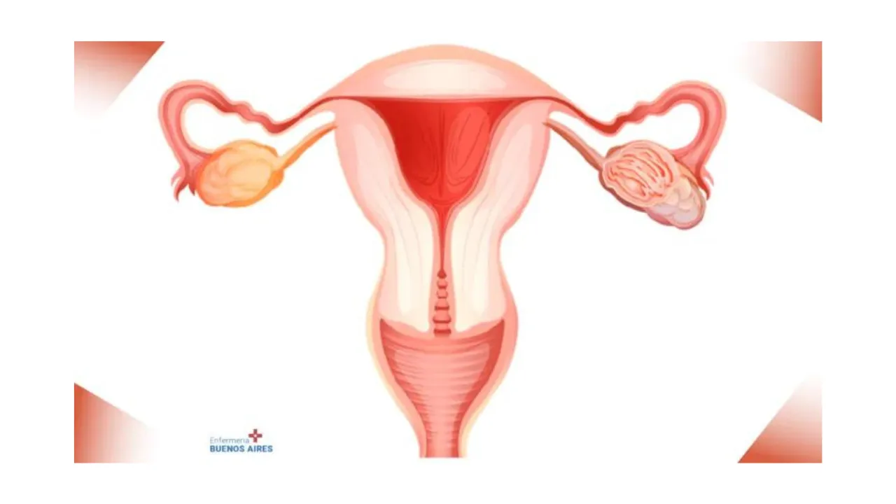 Sarcoma uterino