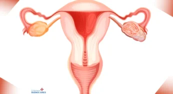 Sarcoma uterino en estadio IV – Tratamiento