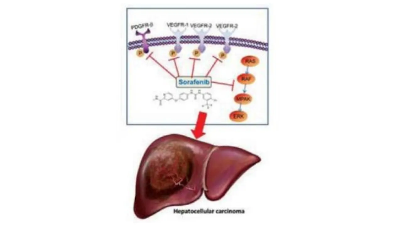 Sorafenib - Tratamiento del Cáncer primario de Hígado