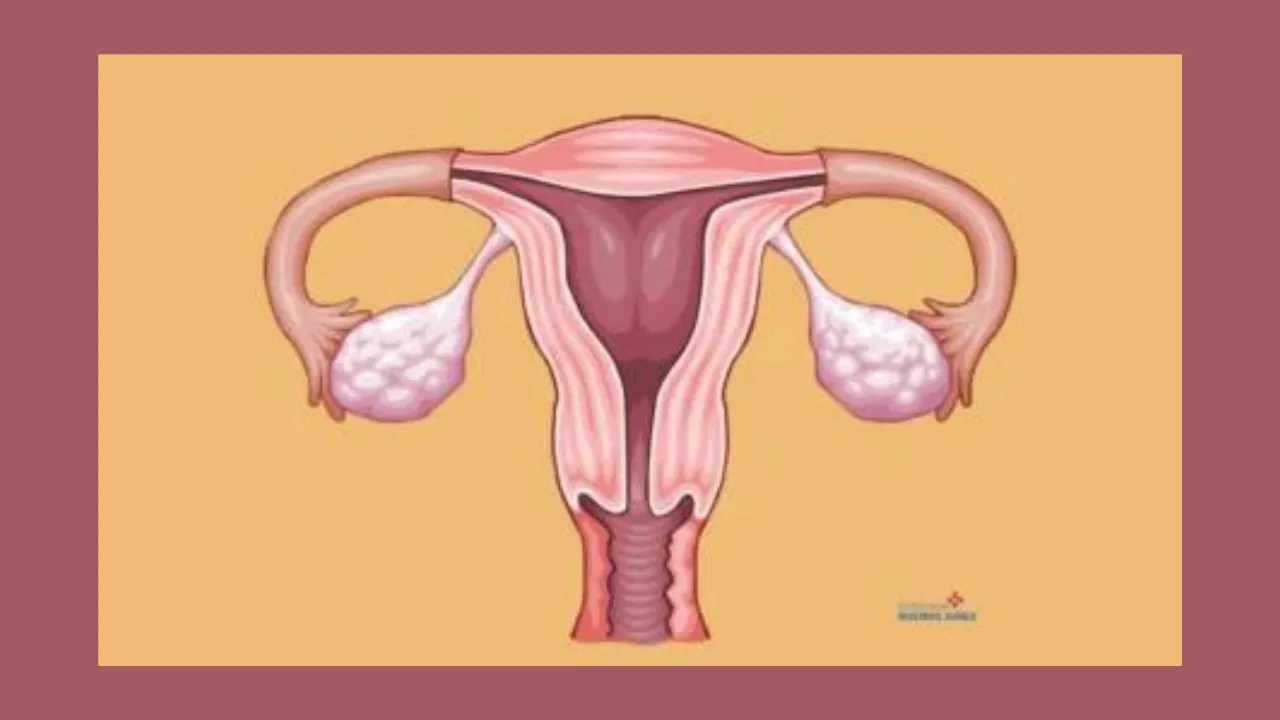 Sarcoma uterino