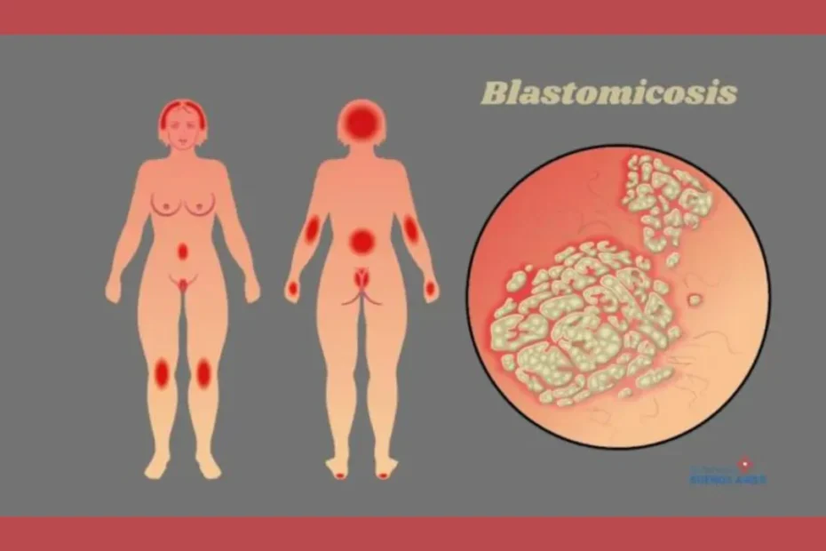 Blastomicosis