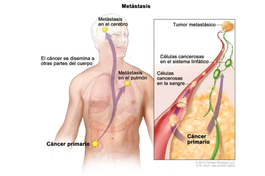 Cáncer metastásico