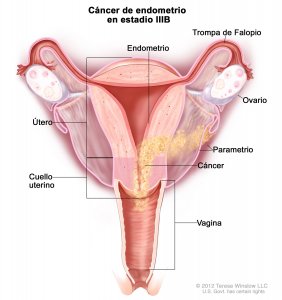Cáncer de endometrio