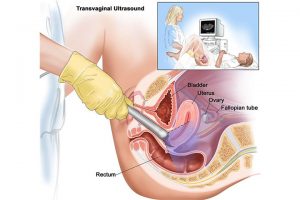 ¿Cómo se detecta el cáncer de endometrio?