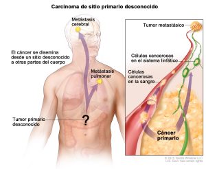 Carcinoma de sitio primario desconocido