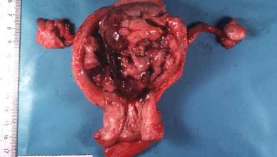 Sarcoma uterino en estadio IV - Tratamiento