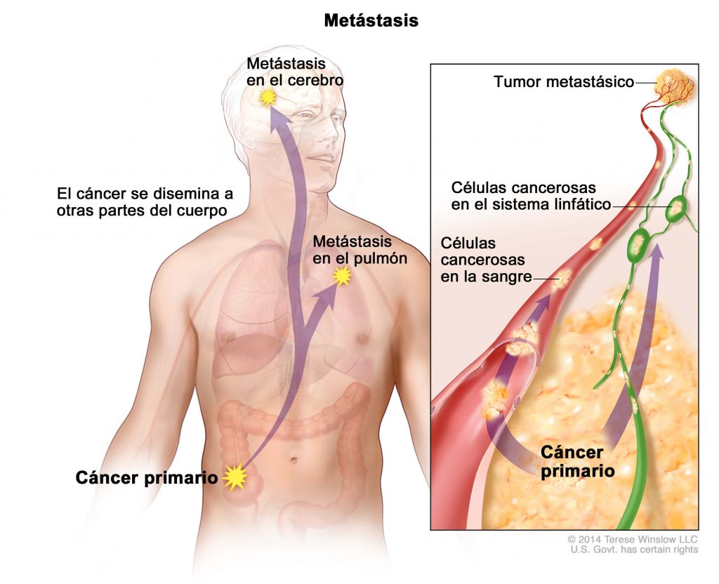 c-ncer-metast-sico