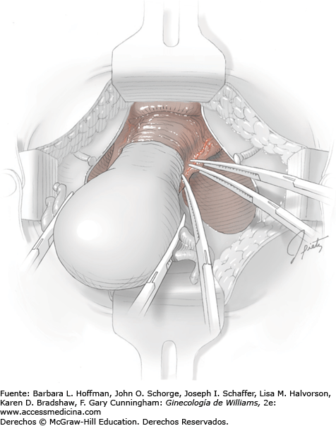 Sarcoma uterino en estadio II y III - Tratamiento