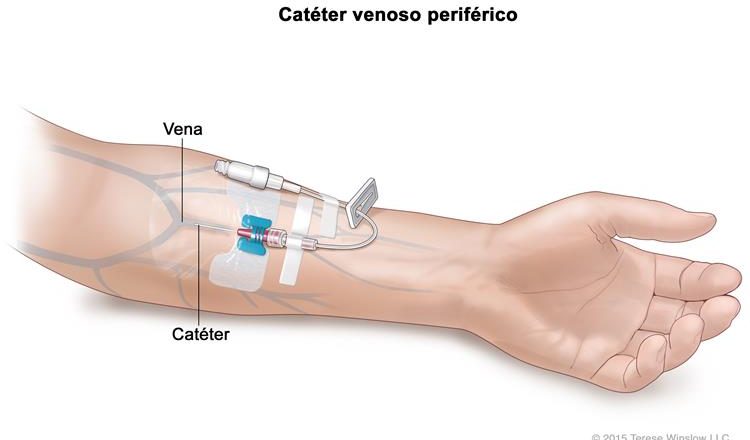 Colocación de catéter venoso periférico