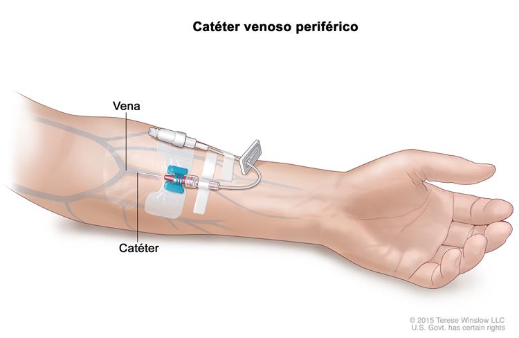 Colocación de catéter venoso periférico