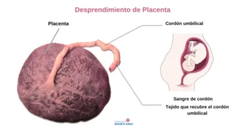 Desprendimiento de la placenta