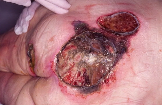 Úlcera antes de desbridamiento