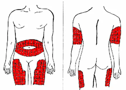 Zonas de punción para la vía subcutánea - Maestría en Farmacología: Vía Subcutánea