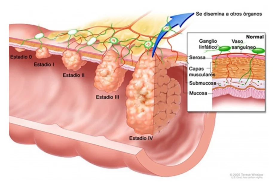 Cancer metastasico sintomas