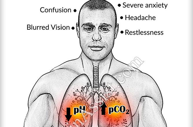acidosis respiratoria 1