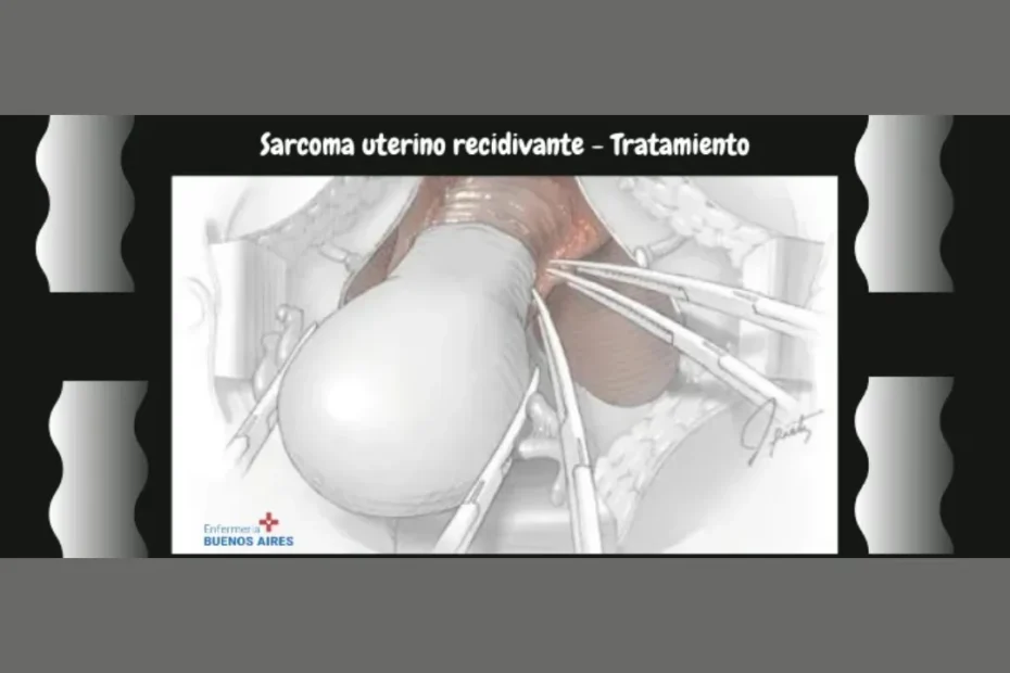 Sarcoma uterino recidivante