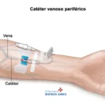 Colocación de catéter venoso periférico