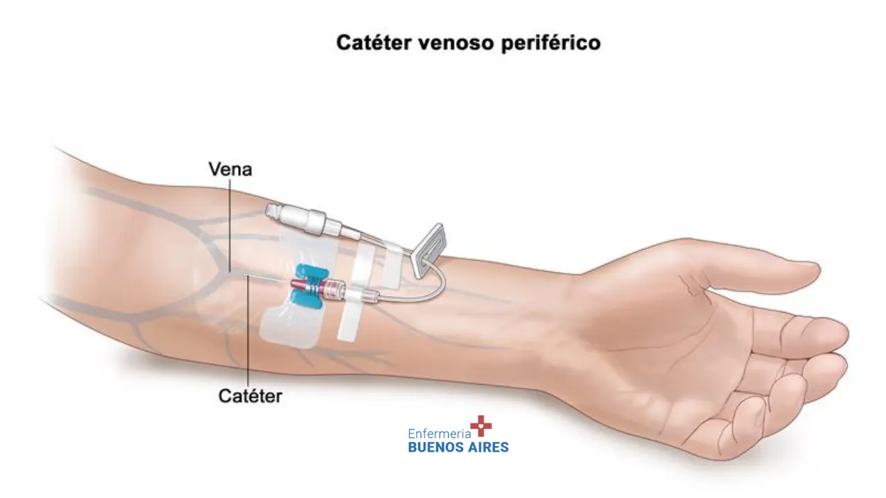 Colocación de catéter venoso periférico