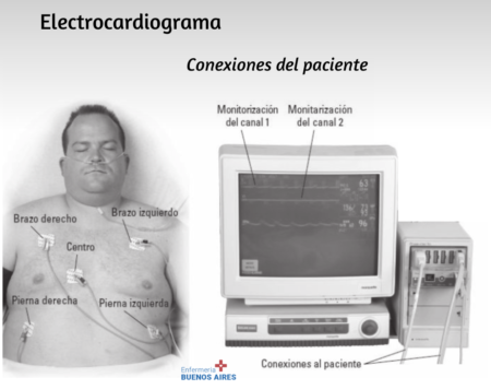 ¿Cómo se colocan los Electrodos del Electrocardiograma?