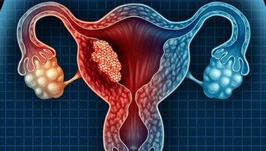 Estadios del sarcoma uterino