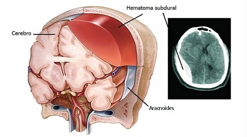 hematoma subdural
