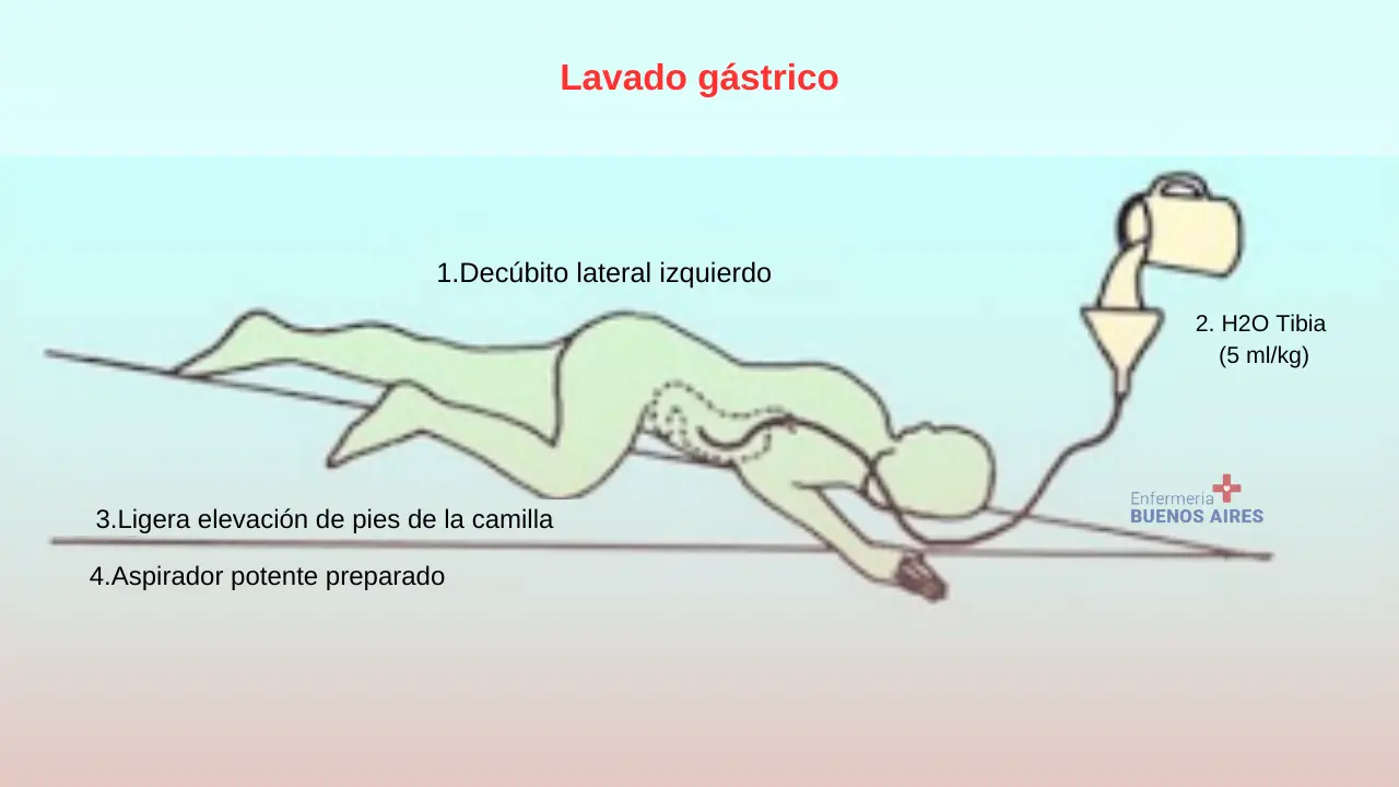 El paciente intoxicado debe colocarse durante el lavado en decúbito lateral izquierdo con la cabeza 10 o 15º más baja (en Trendelenburg) ya que así, al estar la curvatura mayor del estómago en posición declive y el píloro más alto que el cuerpo gástrico, se impide el vaciado del contenido hacia el duodeno.- Lavado gástrico perfecto