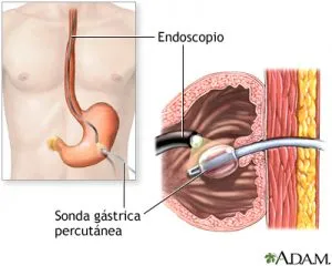 Gastrostomía