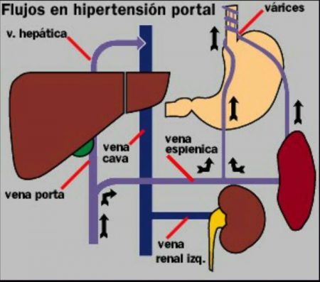 flujos de hipertension portal