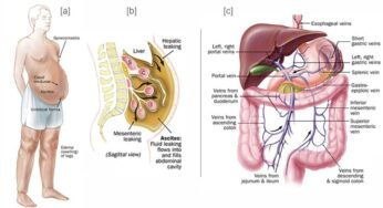 Varices esofágicas y gástricas – Tratamiento y cuidados