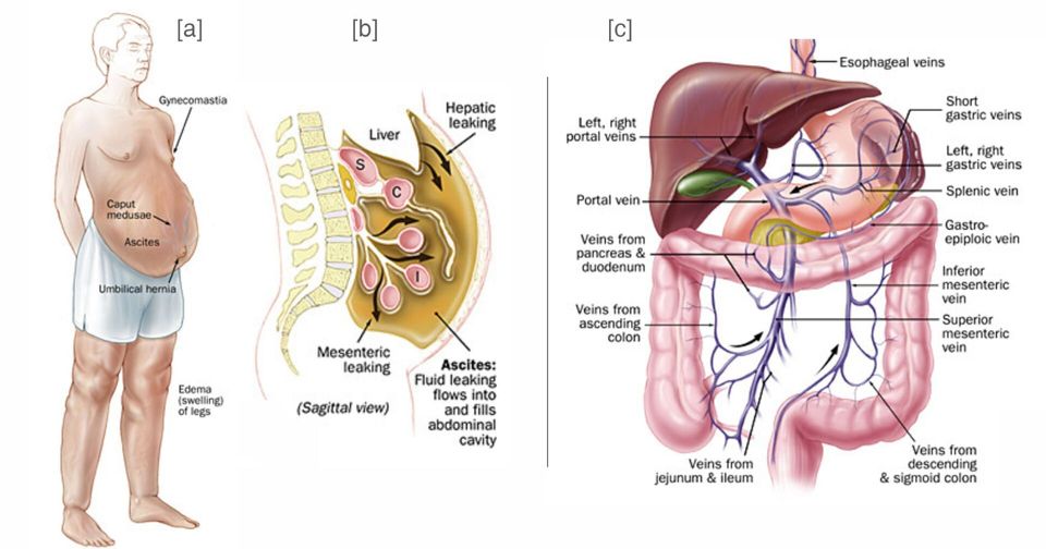 Varices esofágicas y gástricas