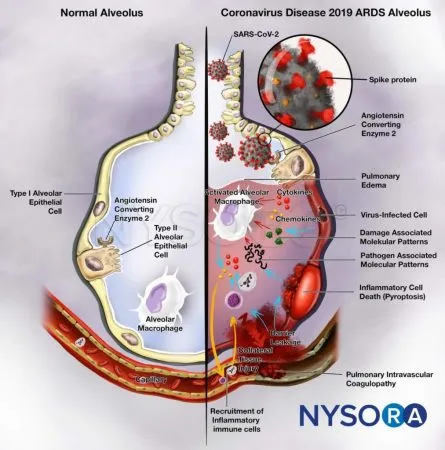 Imagen 9: Síndrome de Dificultad Respiratoria Aguda (SDRA)