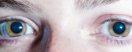pupilas dilatadas