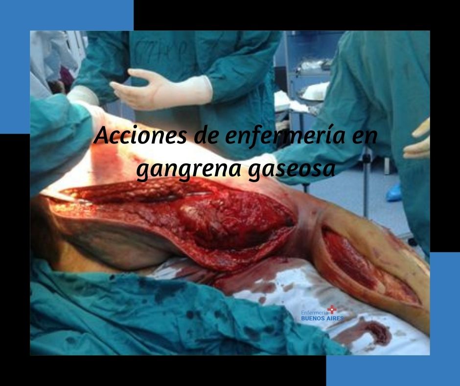Gangrena gaseosa 1