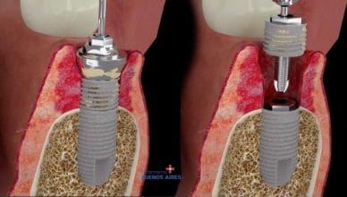 Doble implante dental en la periimplantitis