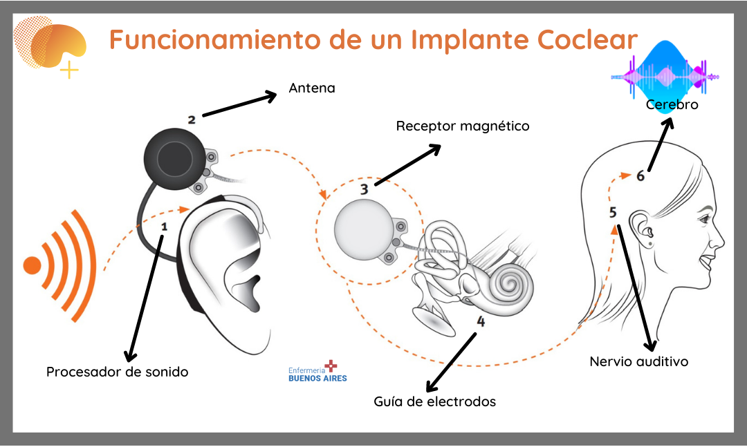 Partes De Un Implante Coclear 9123