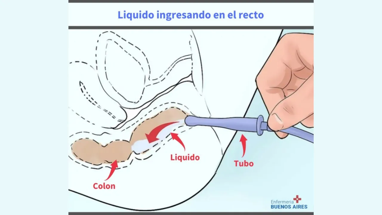 Preparación de un enema jabonoso