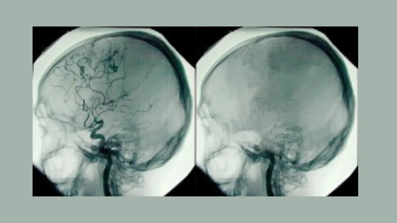 Figura 2 - Angiograma de cerebro: a la izquierda se observa un cerebro con flujo sanguíneo y  a la derecha un cerebro sin flujo sanguíneo; como se vería en un paciente con muerte cerebral.