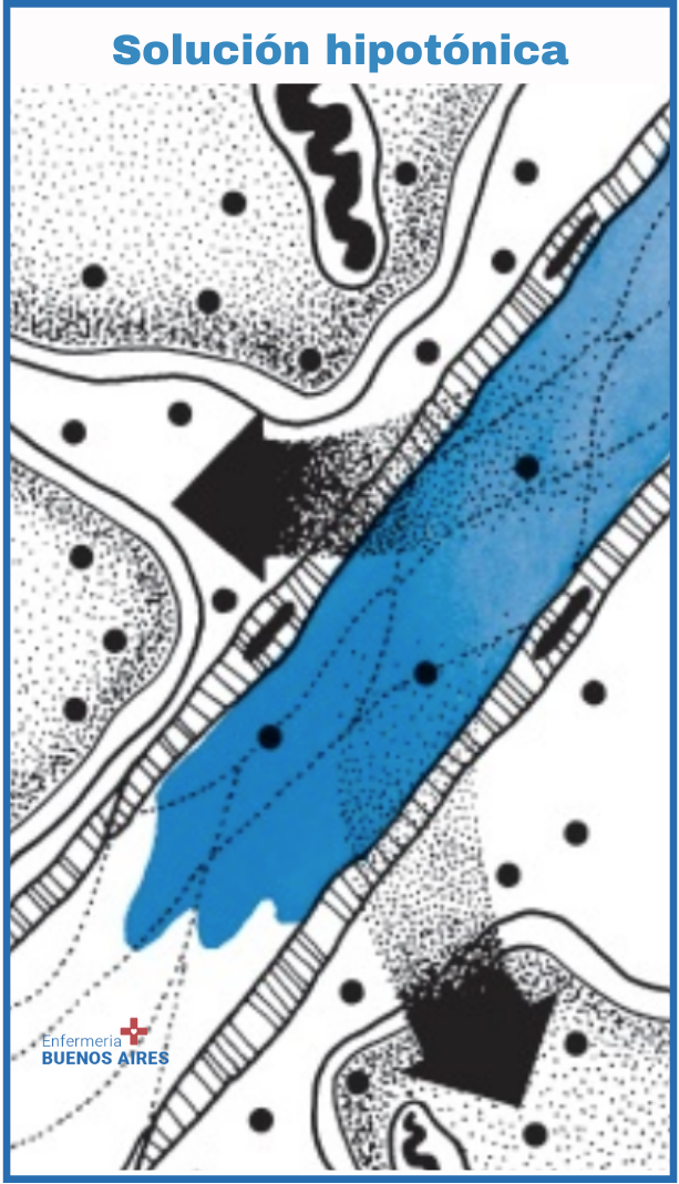 La solución hipotónica tiene una osmolaridad inferior a la del suero. Desplaza líquido fuera del compartimento intravascular, hidratando las células y los compartimentos intersticiales