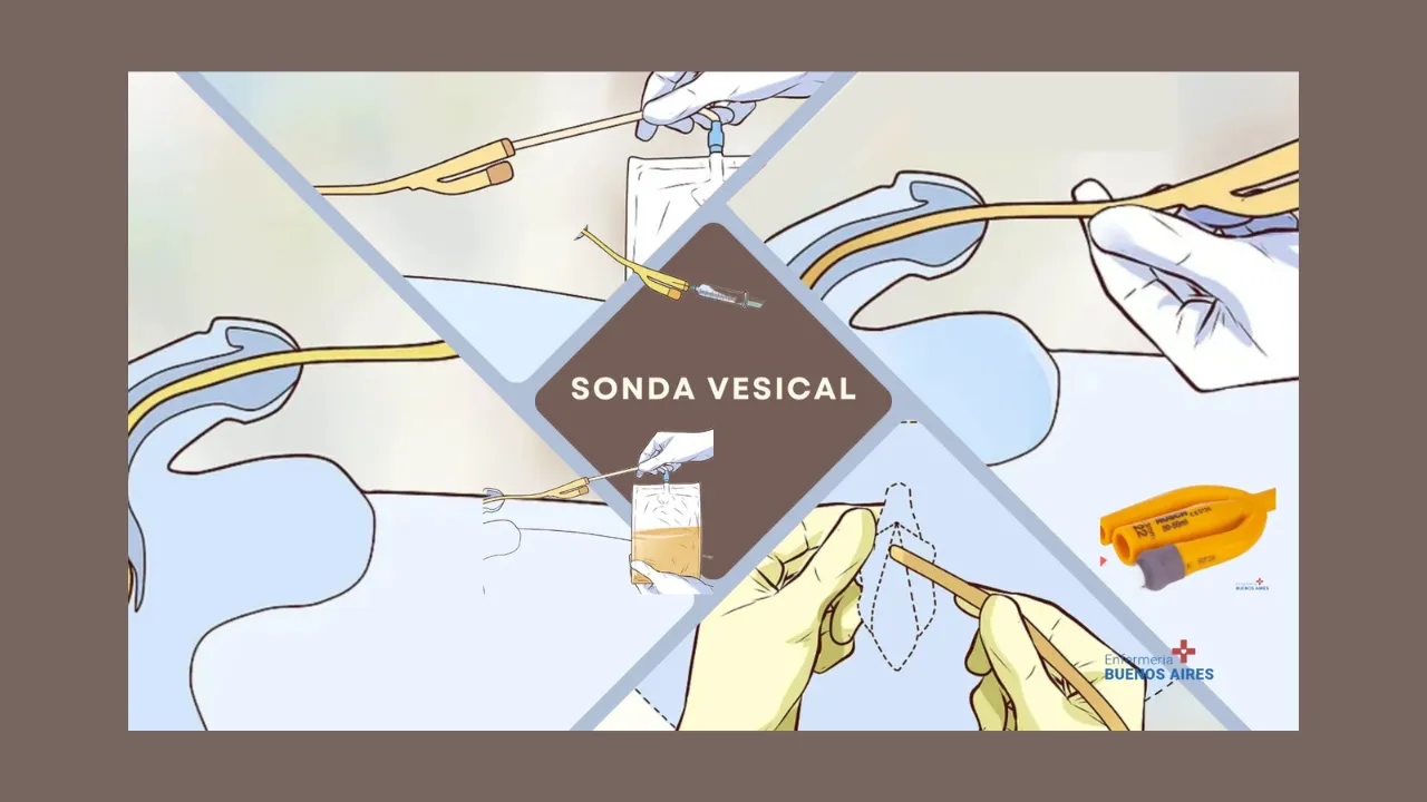 Sonda vesical 3 vias