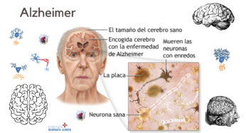 Alzheimer, demencia y deterioro cognitivo